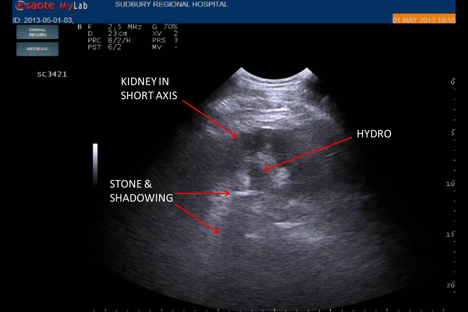 faster-radiation-free-approach-to-renal-colic-with-pocus-ede-ede-blog