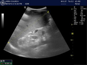 spleen infectious mononucleosis measure enlarged