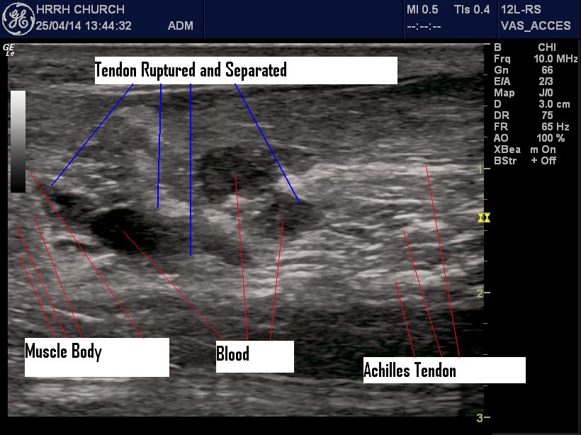 Ruptured Achilles Tendon : EDE Blog